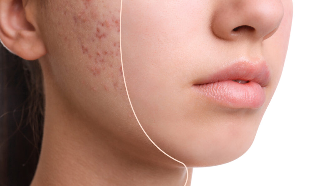 Targeting Acne at Its Root